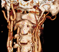Abbildung 1: CTA with 3D reconstruction