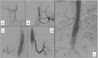 Abbildung 5a-e: Produkt: Stentgraft<br>
Vertrieb: Jotec GmbH