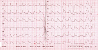 Abbildung 1: EKG