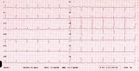 Abbildung 2: EKG