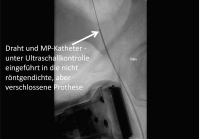 Abbildung 3: DSA - Ultraschall