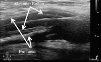 Abbildung 5: Thrombus