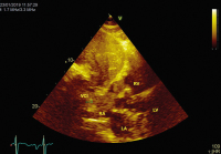 Abbildung 5: Vena cava inferior