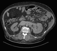 Abbildung 7: CT-Abdomen
