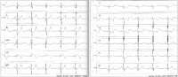 Abbildung 1: Notfall-EKG