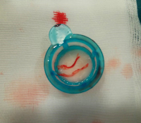 Abbildung 4: Thrombus