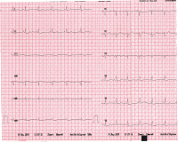 Abbildung 1: EKG