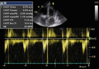 Abbildung 4: PW-Doppler