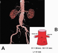 Abbildung 1: Aortenaneurysma