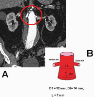 Abbildung 4: Infrarenales Aortenaneurysma