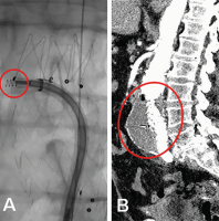 Abbildung 5: EndoAnchor-Implantation