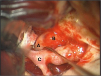 Abbildung 1: Intraoperativer Situs