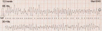 Abbildung 1: ECG