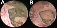 Abbildung 5A-B: Foramen Monroi