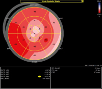 Abbildung 2: Speckle-Tracking-Analyse