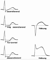 Abbildung 1: ST-Streckenvernderungen