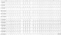Abbildung 1: EKG