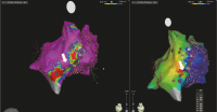 Abbildung 2: Elektroanatomisches Mapping