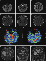 Abbildung 2: Status epilepticus