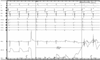 Abbildung 3: Ablation