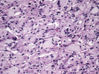 Abbildung 3: Tumor