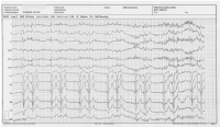 Abbildung 1: EKG