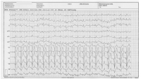 Abbildung 3: EKG