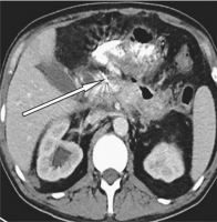 Abbildung 7: Abdomen-CT