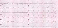 Abbildung 1: EKG