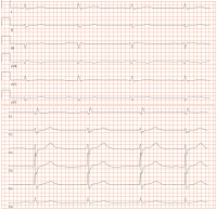 Abbildung 1: EKG