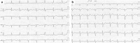 Abbildung 1: EKG