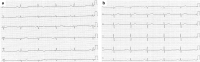 Abbildung 2: EKG