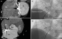 Abbildung 1: Amplatzer-Septal-Occluder