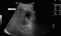 Abbildung 1: Pfortaderthrombose