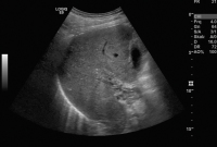 Abbildung 2: Pfortaderthrombose