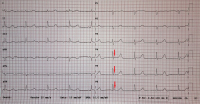 Abbildung 1: EKG