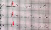 Abbildung 2: EKG