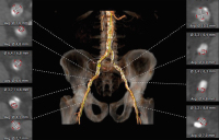 Abbildung 1: Aorta abdominalis - Beckengefe