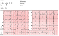 Abbildung 1: EKG