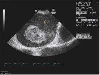 Abbildung 1: Gestielter Vorhofthrombus