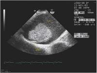 Abbildung 2: Gestielter Vorhofthrombus