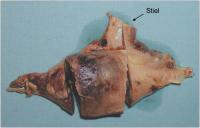 Abbildung 3: Gestielter Vorhofthrombus