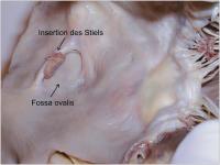 Abbildung 4: Gestielter Vorhofthrombus