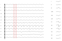 Abbildung 3: Oberflchen-EKG