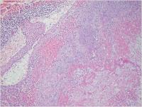 Abbildung 5: Gestielter Vorhofthrombus