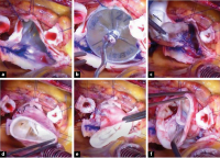 Abbildung 4:  Homograft-Implantation