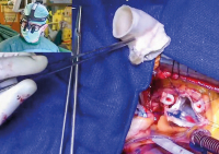 Abbildung 5: Dezellularisierter Homograft