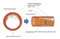 Abbildung 1: Drug-eluting Stent