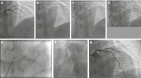 Abbildung 6a-g: Angiogramm