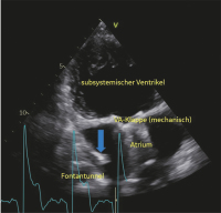 Abbildung 10: Single Ventricle
